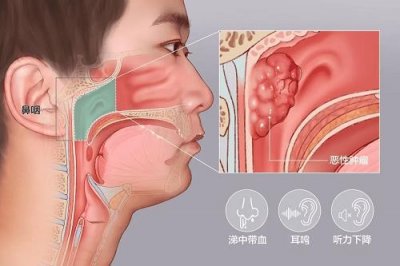 ​回吸涕带血一一这种流鼻血警惕是鼻咽癌的早期信号